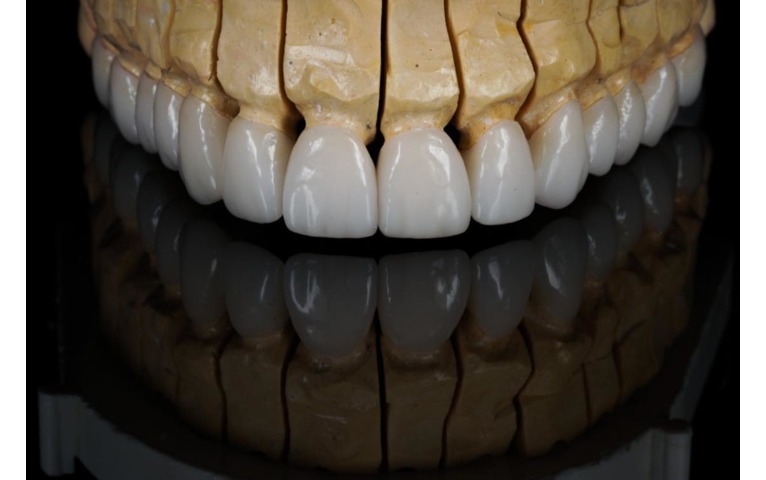 Rozdiel medzi zubnou korunkou a fazetou